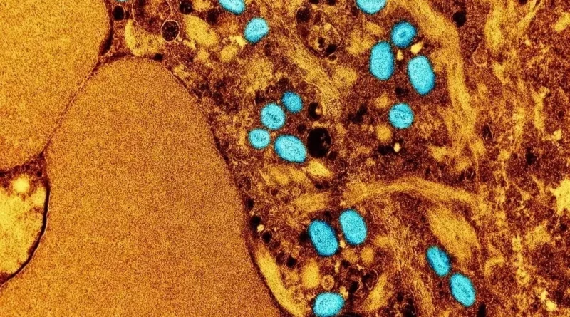 OMS anuncia que Mpox deixa de ser emergência de saúde internacional